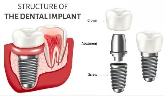 High-Quality Titanium PT Fixture (Pine Tree Fixture) SLA, Tapered Korea Dental Implant Materials